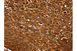 The image on the left is immunohistochemistry of paraffin-embedded Human esophagus cancer tissue using ABIN7192748(TCEB3B Antibody) at dilution 1/25, on the right is treated with synthetic peptide. (TCEB3B anticorps)