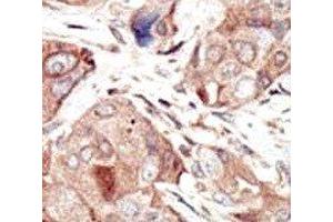 IHC analysis of FFPE human breast carcinoma tissue stained with the VEGFR2 antibody