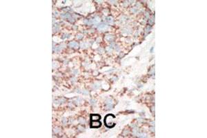 Formalin-fixed and paraffin-embedded human cancer tissue reacted with STK25 polyclonal antibody  , which was peroxidase-conjugated to the secondary antibody, followed by AEC staining. (STK25 anticorps  (C-Term))