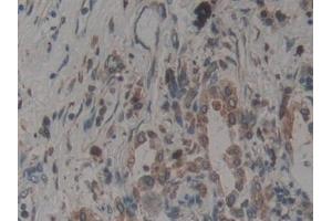 Detection of CNX in Human Lung cancer Tissue using Polyclonal Antibody to Calnexin (CNX)