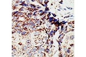 IHC analysis of FFPE human breast carcinoma tissue stained with the BAP1 antibody (BAP1 anticorps  (AA 36-66))