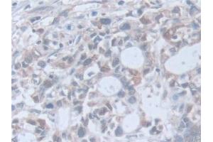 Detection of RARa in Human Stomach cancer Tissue using Polyclonal Antibody to Retinoic Acid Receptor Alpha (RARa)