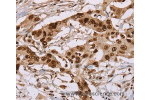 Immunohistochemistry of Human colon cancer using NUP50 Polyclonal Antibody at dilution of 1:30 (NUP50 anticorps)