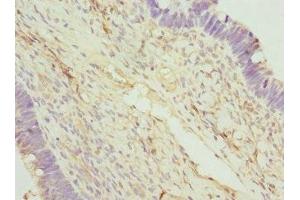 Immunohistochemistry of paraffin-embedded human ovarian cancer using ABIN7166597 at dilution of 1:100 (Small EDRK-Rich Factor 1A (SERF1A) (AA 140-240) anticorps)