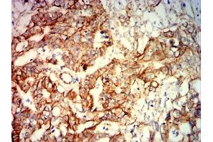 Immunohistochemical analysis of paraffin-embedded rectal cancer tissues using CTNNB1 mouse mAb with DAB staining.