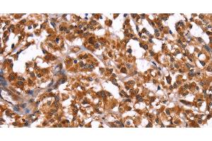 Immunohistochemistry of paraffin-embedded Human thyroid cancer using GUK1 Polyclonal Antibody at dilution of 1:50 (GUK1 anticorps)