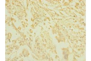 Immunohistochemistry of paraffin-embedded human pancreatic cancer using ABIN7171534 at dilution of 1:100