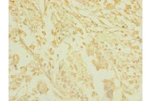 Immunohistochemistry of paraffin-embedded human pancreatic cancer using ABIN7171534 at dilution of 1:100 (TAS1R3 anticorps  (AA 400-570))