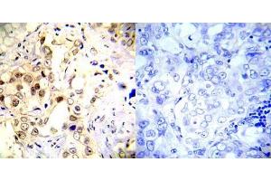 Immunohistochemical analysis of paraffin-embedded human breast carcinoma tissue using P53 (phospho- Ser20) antibody (E012030). (p53 anticorps  (pSer20))