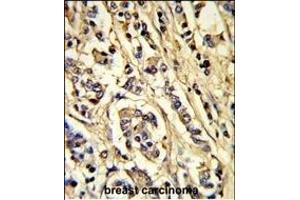 Formalin-fixed and paraffin-embedded human breast carcinoma reacted with VGFR2 Antibody, which was peroxidase-conjugated to the secondary antibody, followed by DAB staining. (VEGFR2/CD309 anticorps)