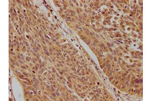 IHC image of ABIN7140203 diluted at 1:100 and staining in paraffin-embedded human cervical cancer performed on a Leica BondTM system.