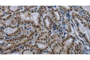Immunohistochemistry of paraffin-embedded Human thyroid cancer tissue using DAN Polyclonal Antibody at dilution 1:50 (PARN anticorps)