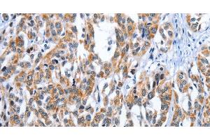 Immunohistochemistry of paraffin-embedded Human esophagus cancer tissue using EDN3 Polyclonal Antibody at dilution 1:30