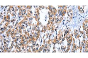 Immunohistochemistry of paraffin-embedded Human esophagus cancer tissue using EDN3 Polyclonal Antibody at dilution 1:30 (Endothelin 3 anticorps)