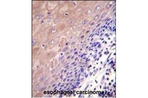 GCLC Antibody (N-term) (ABIN655884 and ABIN2845285) immunohistochemistry analysis in formalin fixed and paraffin embedded human esophageal carcinoma followed by peroxidase conjugation of the secondary antibody and DAB staining.