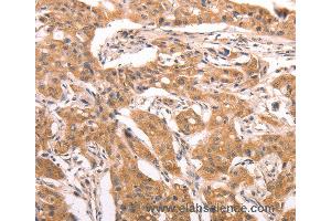 Immunohistochemistry of Human lung cancer using AASDHPPT Polyclonal Antibody at dilution of 1:30 (AASDHPPT anticorps)