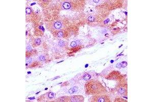 Immunohistochemical analysis of Annexin A4 staining in human liver cancer formalin fixed paraffin embedded tissue section.
