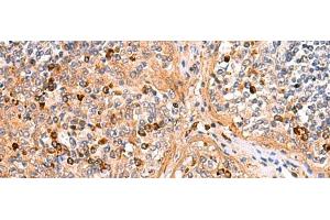 Immunohistochemistry of paraffin-embedded Human liver cancer tissue using KANSL1L Polyclonal Antibody at dilution of 1:40(x200) (KANSL1L anticorps)