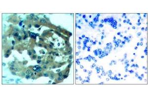 Immunohistochemical analysis of paraffin-embedded human lung carcinoma tissue, using Merlin (Ab-518) antibody (E021258). (Merlin anticorps)
