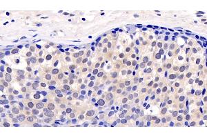 Detection of ERK2 in Human Breast cancer Tissue using Monoclonal Antibody to Extracellular Signal Regulated Kinase 2 (ERK2)