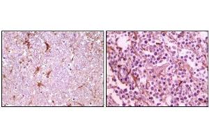 Immunohistochemical analysis of paraffin-embedded human thalamus (left) and glioma (right) tissue, showing membrane localization using CIB1 mouse mAb with DAB staining. (CIB1 anticorps)