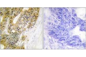 Immunohistochemistry analysis of paraffin-embedded human colon carcinoma tissue, using MDM2 (Ab-186/188) Antibody.