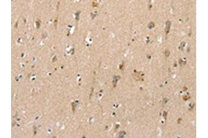 The image on the left is immunohistochemistry of paraffin-embedded Human brain tissue using ABIN7192520(SLC6A8 Antibody) at dilution 1/30, on the right is treated with synthetic peptide.