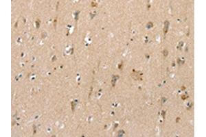 The image on the left is immunohistochemistry of paraffin-embedded Human brain tissue using ABIN7192520(SLC6A8 Antibody) at dilution 1/30, on the right is treated with synthetic peptide. (SLC6A8 anticorps)