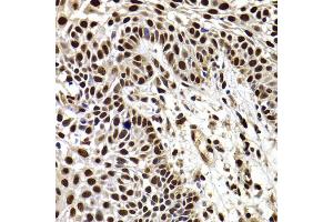 Immunohistochemistry of paraffin-embedded human well-differentiated squamous skin carcinoma using HIRIP3 antibody (ABIN5974221) at dilution of 1/100 (40x lens). (HIRIP3 anticorps)