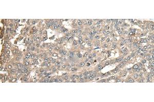 Immunohistochemistry of paraffin-embedded Human liver cancer tissue using ATXN3 Polyclonal Antibody at dilution of 1:100(x200) (Ataxin 3 anticorps)