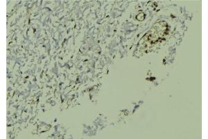 ABIN6272970 at 1/100 staining Human breast cancer tissue by IHC-P. (NR1H2 anticorps  (Internal Region))