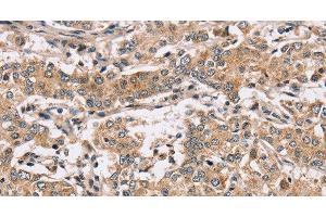 Immunohistochemistry of paraffin-embedded Human liver cancer using PPP1CC Polyclonal Antibody at dilution of 1:40 (PPP1CC anticorps)