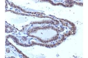 IHC testing of FFPE human thyroid carcinoma with TSHR antibody (clone SPM223).