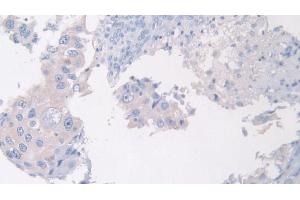 Detection of PANK4 in Human Breast cancer Tissue using Polyclonal Antibody to Pantothenate Kinase 4 (PANK4)