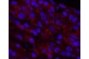 Immunofluorescence analysis of Human lung cancer tissue using Cleaved-NOTCH1 (V1754) Polyclonal Antibody at dilution of 1:200.