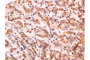 Formalin-fixed and paraffin embedded human gastric carcinoma labeled with Anti-CD99L2 Polyclonal Antibody, Unconjugated  at 1:200 followed by conjugation to the secondary antibody and DAB staining. (CD99L2 anticorps  (AA 81-187))