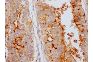 IHC image of ABIN7127379 diluted at 1:100 and staining in paraffin-embedded human endometrial cancer performed on a Leica BondTM system. (Recombinant MUC16 anticorps)