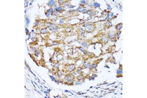 Immunohistochemistry of paraffin-embedded human breast cancer using NDE1 antibody (ABIN5974277) at dilution of 1/100 (40x lens). (NDE1 anticorps)