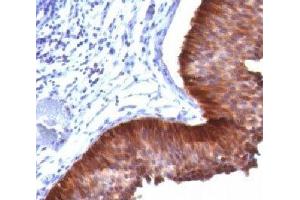 IHC testing of bladder carcinoma stained with Cytokeratin 17 antibody. (KRT17 anticorps)