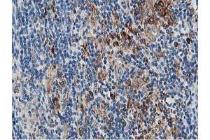 Immunohistochemical staining of paraffin-embedded Human lymphoma tissue using anti-PTPN1 mouse monoclonal antibody. (PTPN1 anticorps)