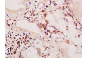 Formalin-fixed and paraffin embedded human colon carcinoma labeled with Anti-phospho-PIK3C3(Ser164)Polyclonal Antibody, Unconjugated  at 1:200 followed by conjugation to the secondary antibody and DAB staining (PIK3C3 anticorps  (pSer164))