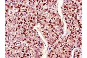 Immunohistochemistry of paraffin-embedded human liver cancer using ABIN7150711 at dilution of 1:100 (MAP2K4 anticorps  (AA 259-398))