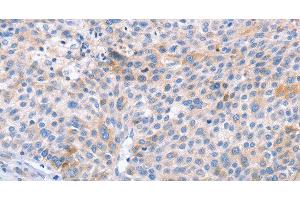 Immunohistochemistry of paraffin-embedded Human liver cancer using STK4 Polyclonal Antibody at dilution of 1:70 (STK4 anticorps)