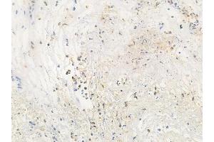 ABIN6263346 and ABIN6266864 at 1/100 staining human breast carcinoma by IHC-P.
