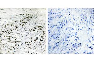 Peptide - +Immunohistochemistry analysis of paraffin-embedded human breast carcinoma tissue, using ERF antibody. (ERF anticorps  (Internal Region))