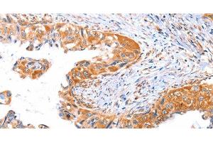 Immunohistochemistry of paraffin-embedded Human cervical cancer tissue using AP1B1 Polyclonal Antibody at dilution 1:70