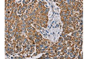 The image on the left is immunohistochemistry of paraffin-embedded Human lung cancer tissue using ABIN7130290(MTFP1 Antibody) at dilution 1/30, on the right is treated with fusion protein. (Mtfp1 anticorps)