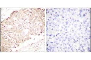 Immunohistochemistry analysis of paraffin-embedded human breast carcinoma tissue, using SENP1 Antibody.