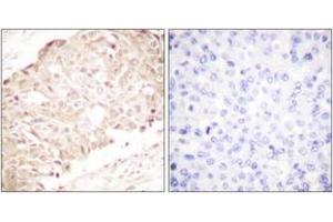 Immunohistochemistry analysis of paraffin-embedded human breast carcinoma tissue, using SENP1 Antibody. (SENP1 anticorps  (AA 1-50))