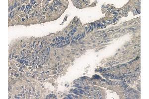 ABIN6255502 and ABIN6267099 at 1/100 staining human colon carcinoma by IHC-P. (BIM anticorps  (pSer77))